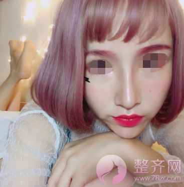 关于隆鼻手术,你应该知道的那些内幕!
