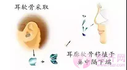 关于隆鼻手术,你应该知道的那些内幕!