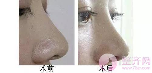 关于隆鼻手术,你应该知道的那些内幕!