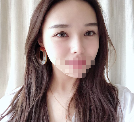 隆鼻,极受欢迎的整形项目