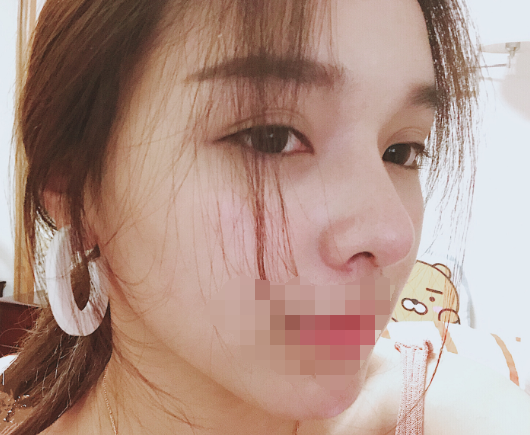 隆鼻,极受欢迎的整形项目