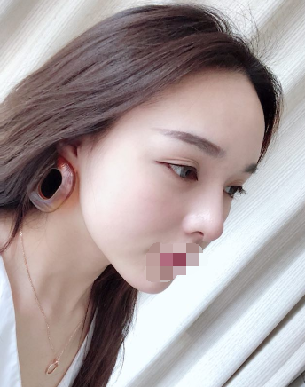 隆鼻,极受欢迎的整形项目