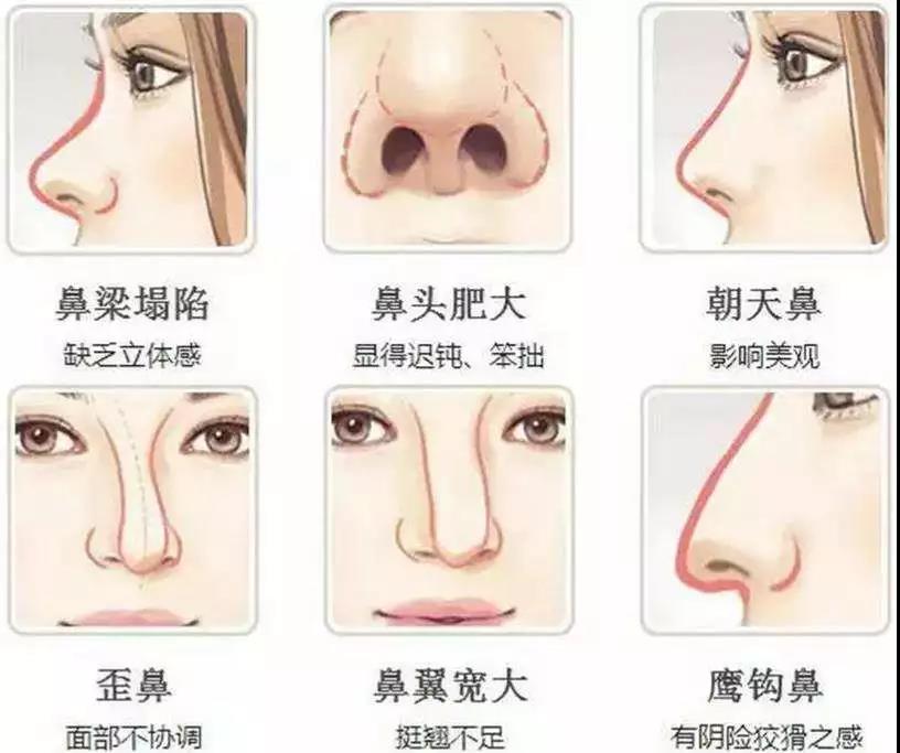 隆鼻,极受欢迎的整形项目