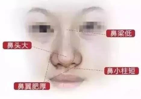 隆鼻,极受欢迎的整形项目