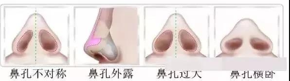 隆鼻,极受欢迎的整形项目