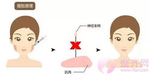 “脸大就要怪骨头”?No!你需要注射瘦脸!