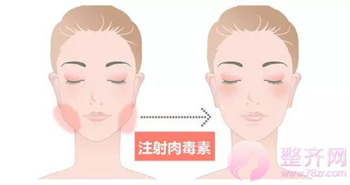 “脸大就要怪骨头”?No!你需要注射瘦脸!