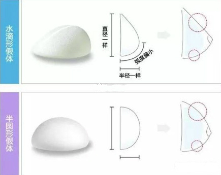 隆胸怎么选择适合自己的假体材料?