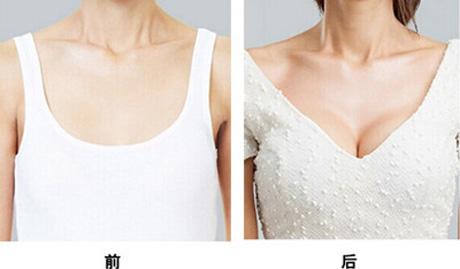 隆胸怎么选择适合自己的假体材料?