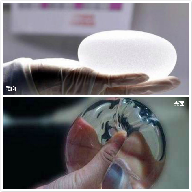 隆胸怎么选择适合自己的假体材料?