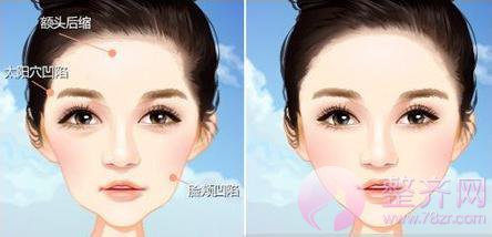 自体脂肪填充,这几个部位做了较减龄……