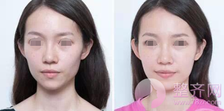 自体脂肪填充,这几个部位做了较减龄……