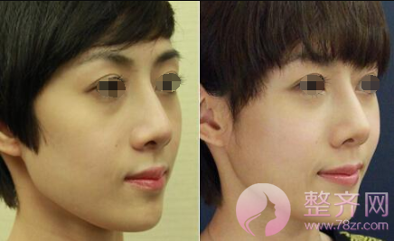 自体脂肪填充,这几个部位做了较减龄……