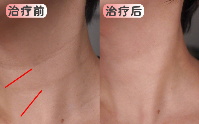 “纳米脂肪”究竟是什么?能用来干什么?