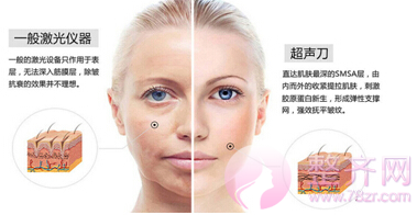 超声提拉在紧致抗衰方面有哪些优势?