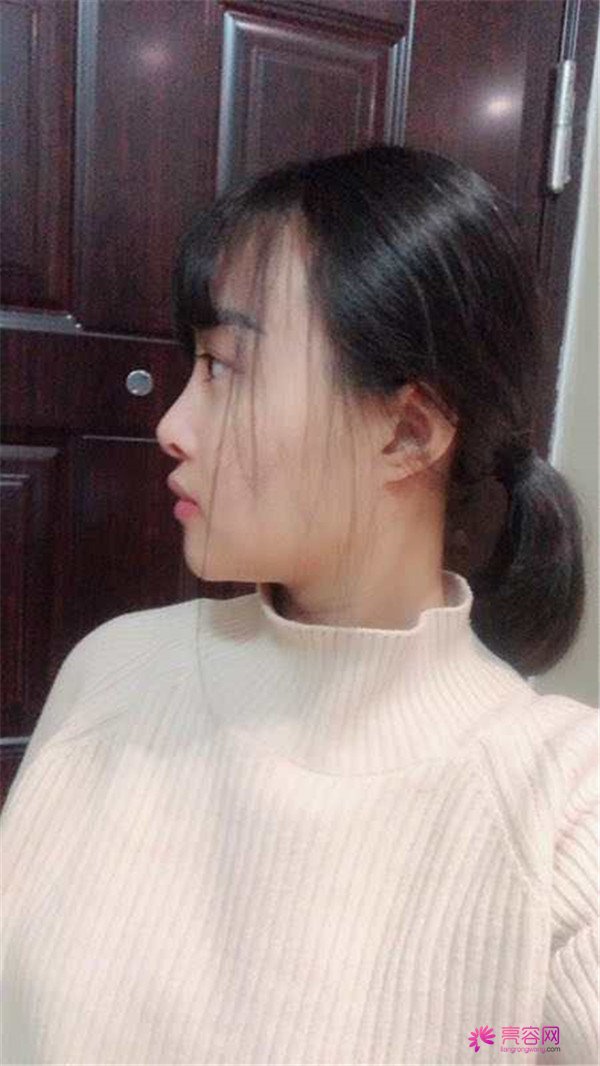 时间过得真快,说着说着5月都过了大半了,我做了埋线提升提升一个月案例分享,做一个漂亮全新的自己。