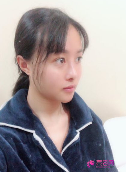 时间过得真快,说着说着5月都过了大半了,我做了埋线提升提升一个月案例分享,做一个漂亮全新的自己。