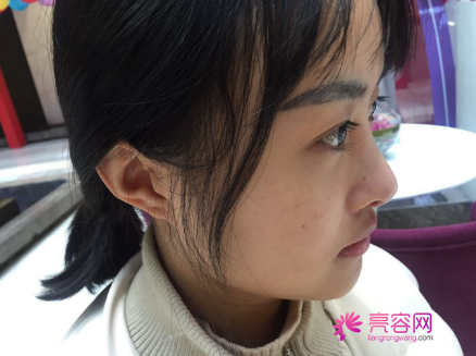 时间过得真快,说着说着5月都过了大半了,我做了埋线提升提升一个月案例分享,做一个漂亮全新的自己。