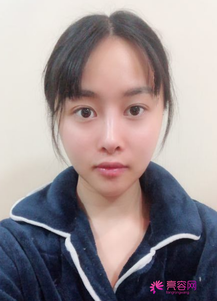 时间过得真快,说着说着5月都过了大半了,我做了埋线提升提升一个月案例分享,做一个漂亮全新的自己。