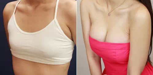 自体脂肪丰胸,5个小常识你知道吗?