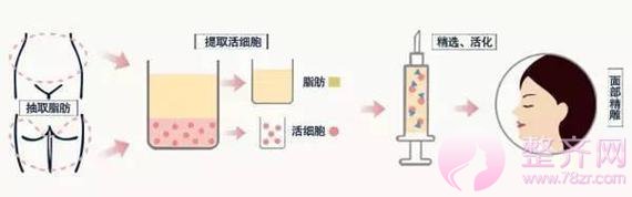 自体脂肪填充面部的五大误区,你都知道吗?