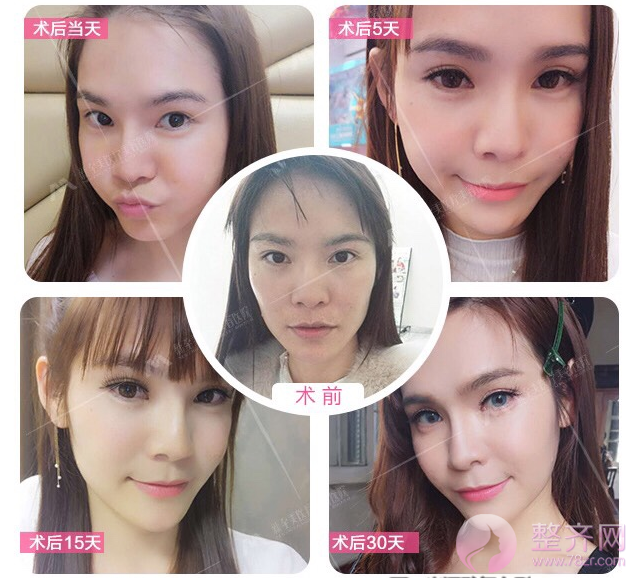 自体脂肪填充面部的五大误区,你都知道吗?