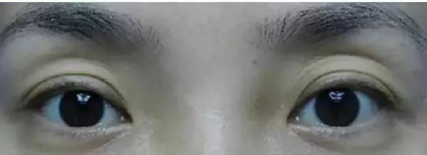 错把眼窝凹陷当做欧式深邃?醒醒吧!那样显老