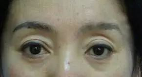 错把眼窝凹陷当做欧式深邃?醒醒吧!那样显老