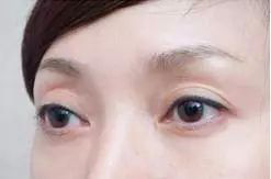 错把眼窝凹陷当做欧式深邃?醒醒吧!那样显老