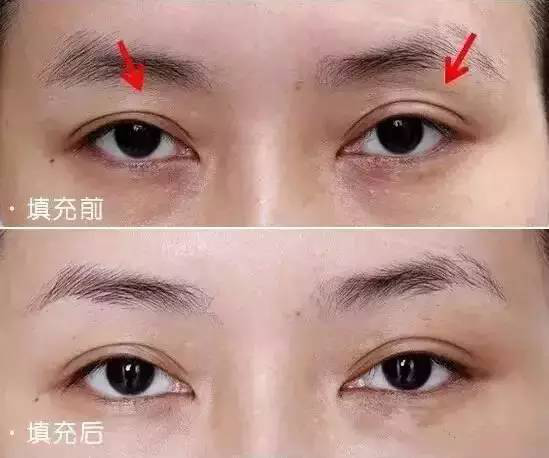 错把眼窝凹陷当做欧式深邃?醒醒吧!那样显老