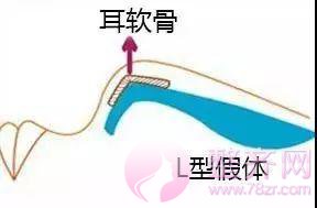 鼻部手术, 到底能有多美?
