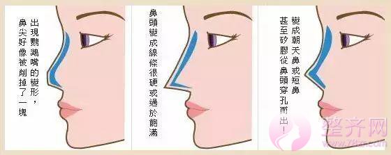 鼻部手术, 到底能有多美?