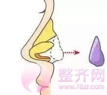 鼻部手术, 到底能有多美?