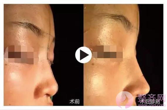 单纯隆鼻or鼻部手术,应该怎么选择?
