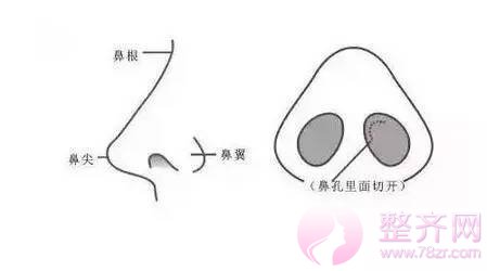 单纯隆鼻or鼻部手术,应该怎么选择?