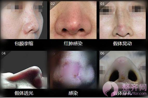 什么情况下鼻子需要修复?