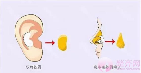 什么情况下鼻子需要修复?
