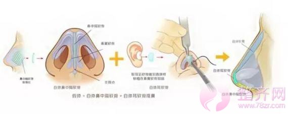 什么情况下鼻子需要修复?
