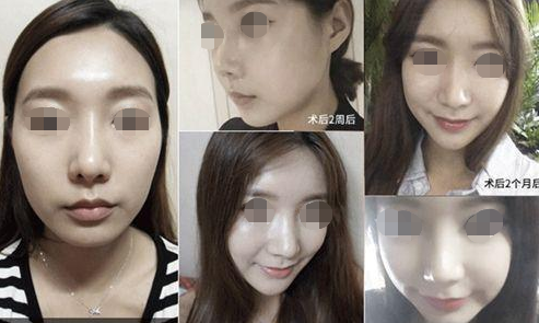 颧骨高不想磨骨,如何解决?这个攻略送给你