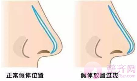假体隆鼻,你选硅胶还是膨体? 这下有定论了