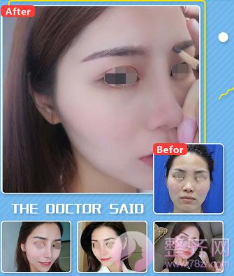 假体隆鼻,你选硅胶还是膨体? 这下有定论了