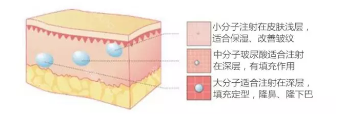 玻尿酸隆鼻,美得无形!