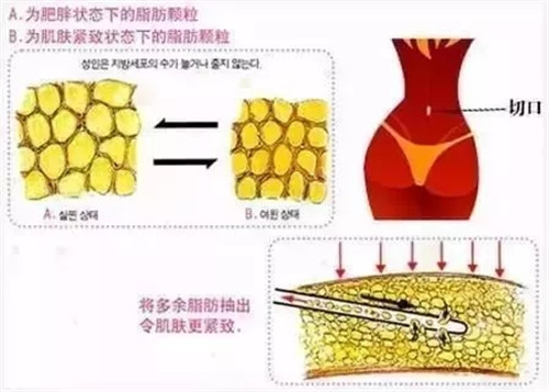 溶脂和吸脂有什么区别?