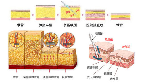 溶脂和吸脂有什么区别?