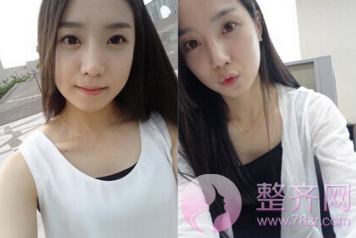为什么那么多人热衷于下颌角手术?