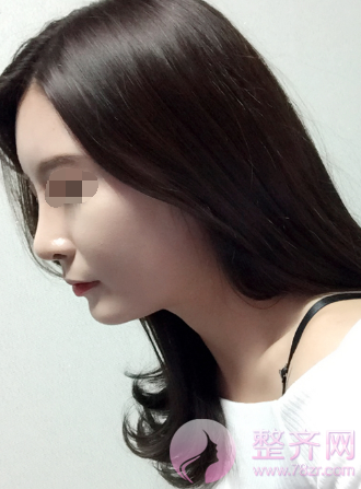 武汉鼻部手术、面部脂肪填充手术术后2个月案例分
