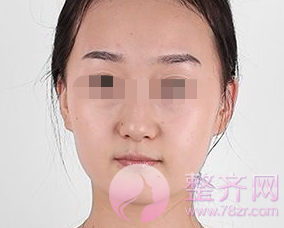苹果肌干瘪,没有笑容力量?