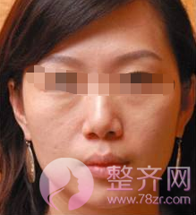 苹果肌干瘪,没有笑容力量?
