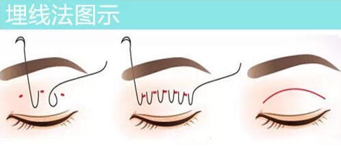 欧式大平行双眼皮貌似成为主流?看看你合不合