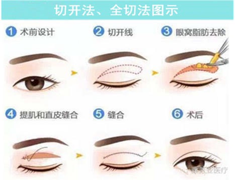 欧式大平行双眼皮貌似成为主流?看看你合不合